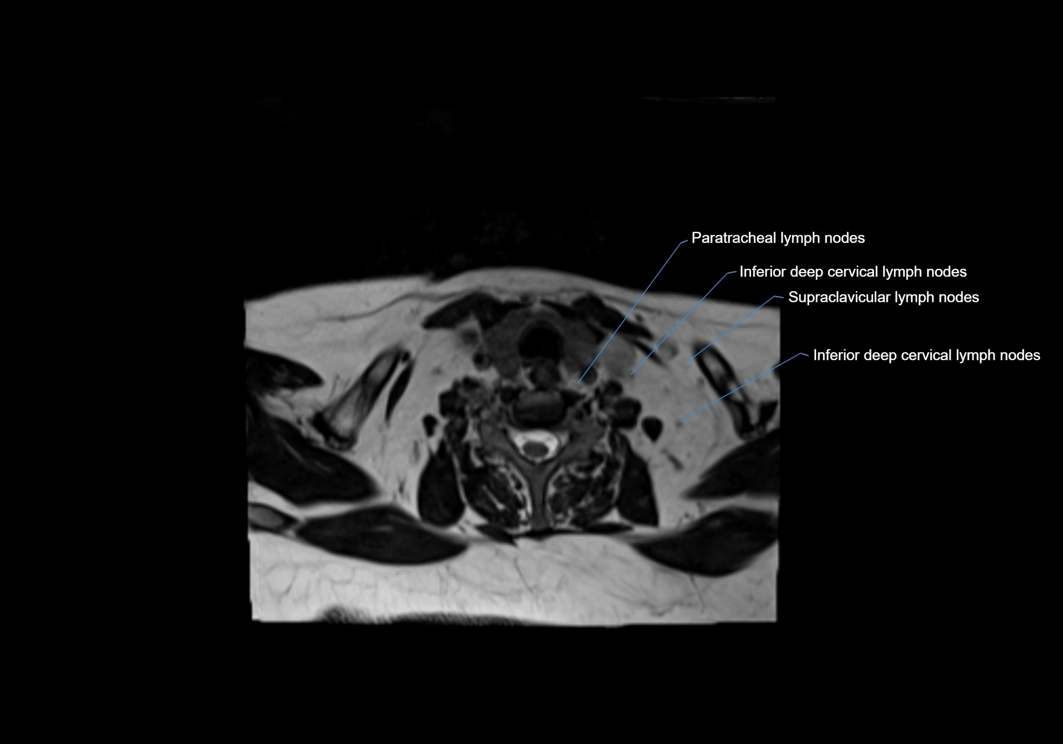 Neck axial  lymph node cross sectional MRI anatomy 3T MRI  image-img-00001-00079.webp